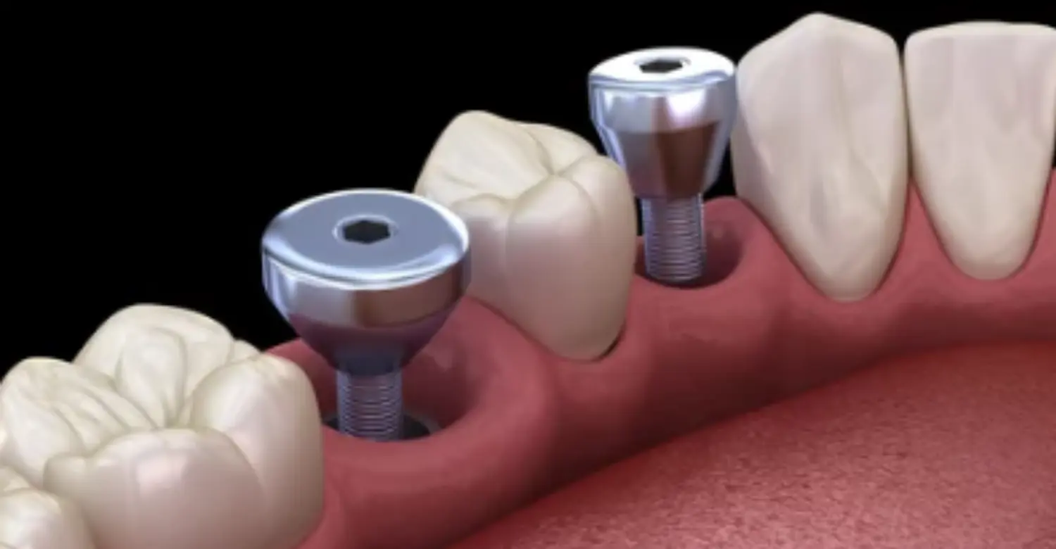 Healing Abutments 2